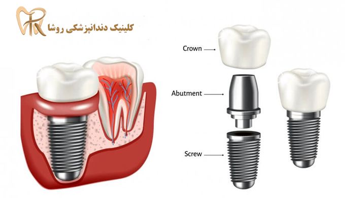 ایمپلنت دندان چیست ؟ (هزینه ایمپلنت دندان 1400) تخفیف ویژه