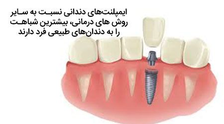 مزیت ایمپلنت های دندانی