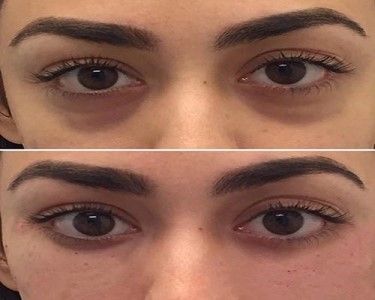 رفع تیرگی و گودی زیر چشم به کدام روش بهتر است؟