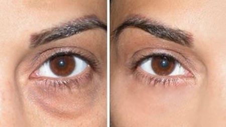 رفع تیرگی و گودی زیر چشم به کدام روش بهتر است؟