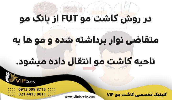 کلینیک کاشت مو vip کاشت مو بدون کوتاهی