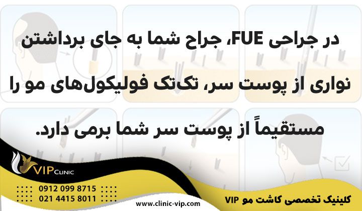 کاشت مو fue