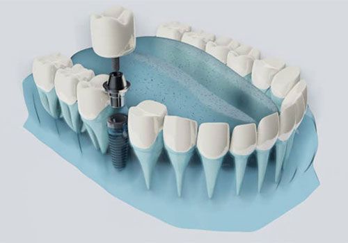 جراحی ایمپلنت دیجیتال دندان