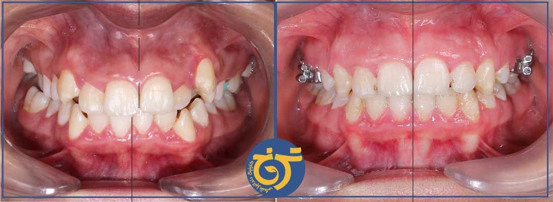 قبل و بعد از درمان ارتودنسی در کلینیک دندانپزشکی ترنج در شرق تهران