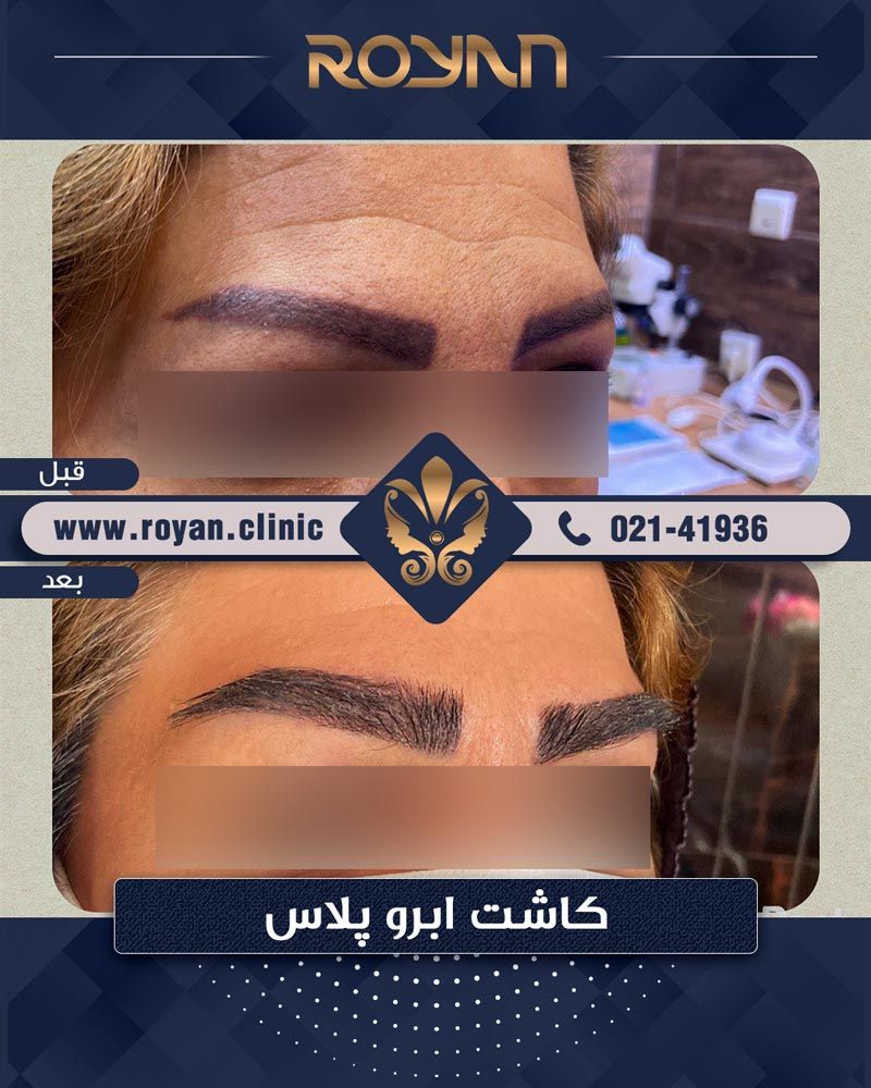 نمونه کاشت ابرو کلینیک رویان سلامت