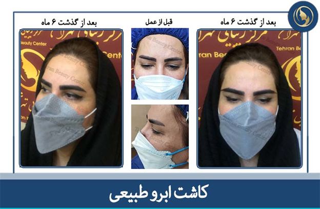 راه حل دائمی برای داشتن ابروهای پرپشت و طبیعی