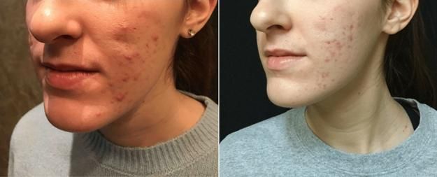 مزایا و معایب استفاده از سابسیژن در درمان جای زخم و جوش