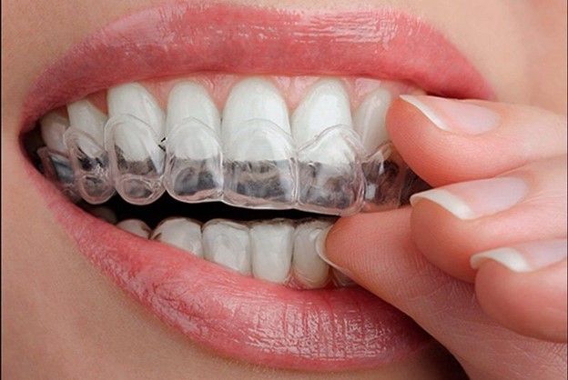 سریع ترین روش های سفید کردن دندان: مزایا و معایب