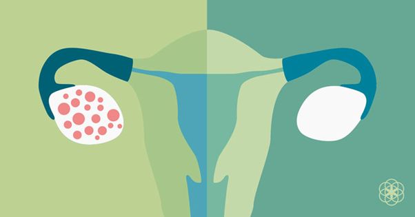 تنبلی تخمدان؛ بیماری شایع زنان