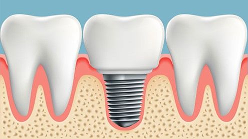 ایمپلنت دندان یک روزه، مزایا و عوارض آن