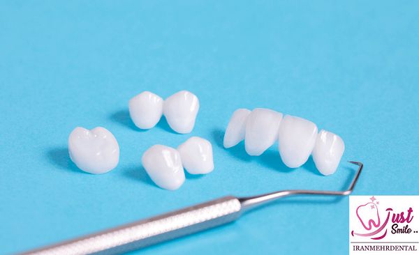 لمینت دندان چیست و انواع آن کدام است؟