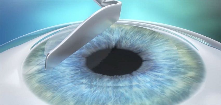 عمل لازک چشم از جمله جراحی های لیزری چشم است که مورد توجه زیادی قرار می گیرد.