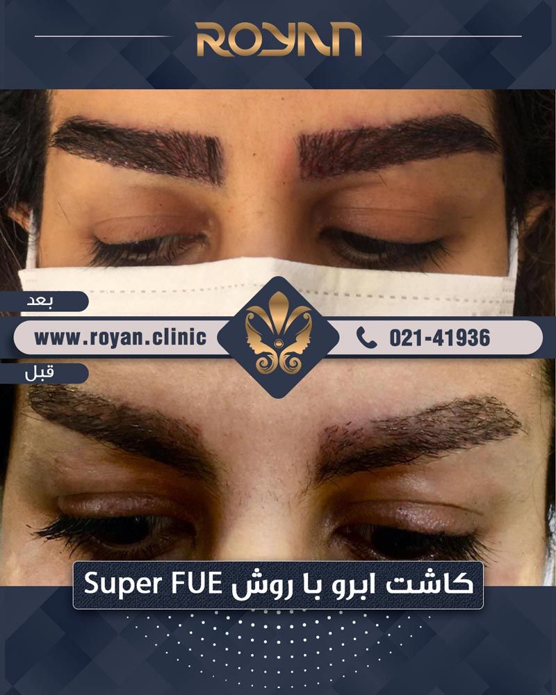 نمونه کاشت ابرو