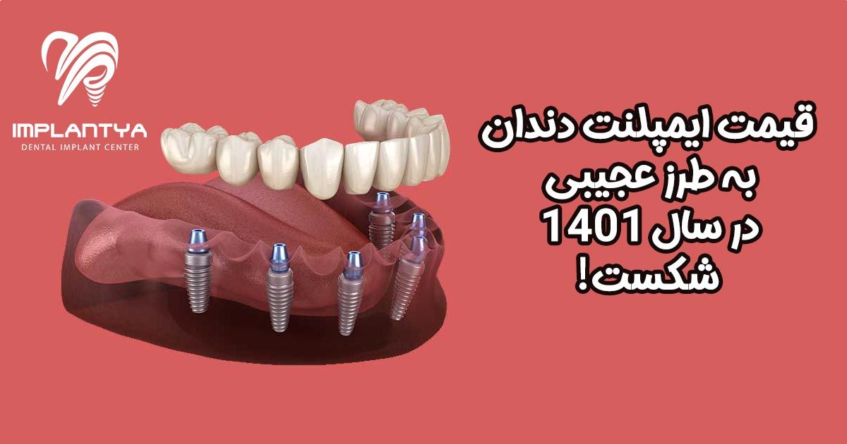 قیمت ایمپلنت دندان