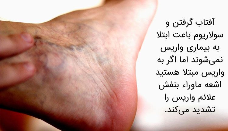 واریس مچ پا 