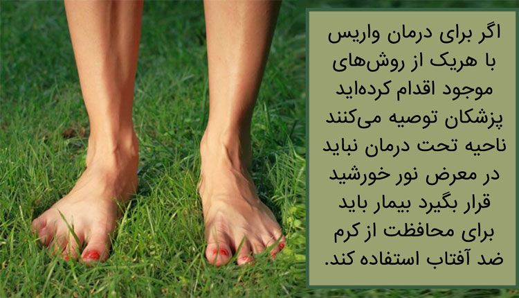 بیماری واریس پا 