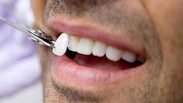 سفید شدن دندان در دندانپزشکی