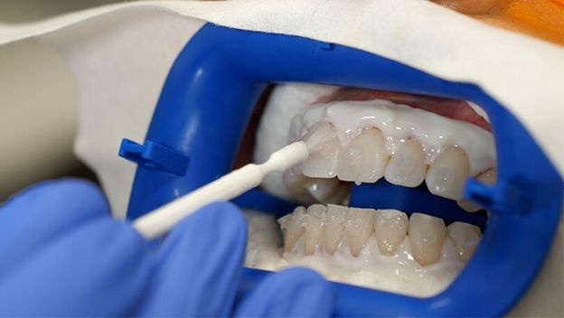 راه های سفید کردن دندان در دندانپزشکی
