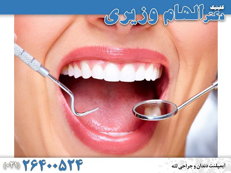 ایمپلنت دندان در تهران