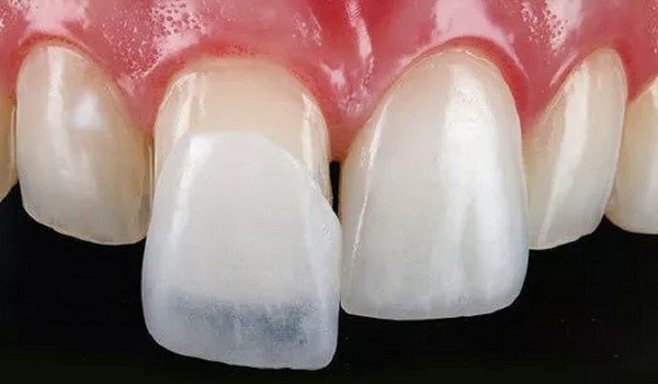 مشکلات کامپوزیت دندان