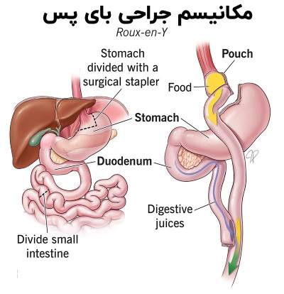 روش عمل جراحی بای پس معده