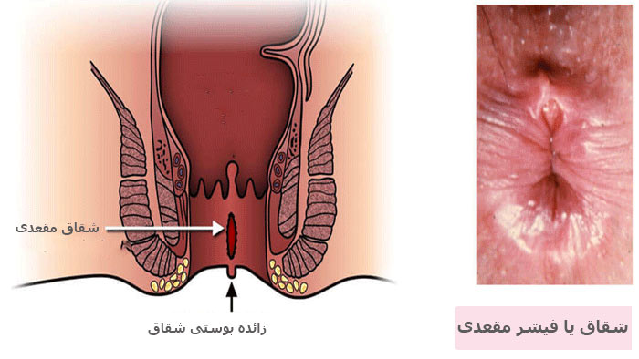 فیشر مقعد