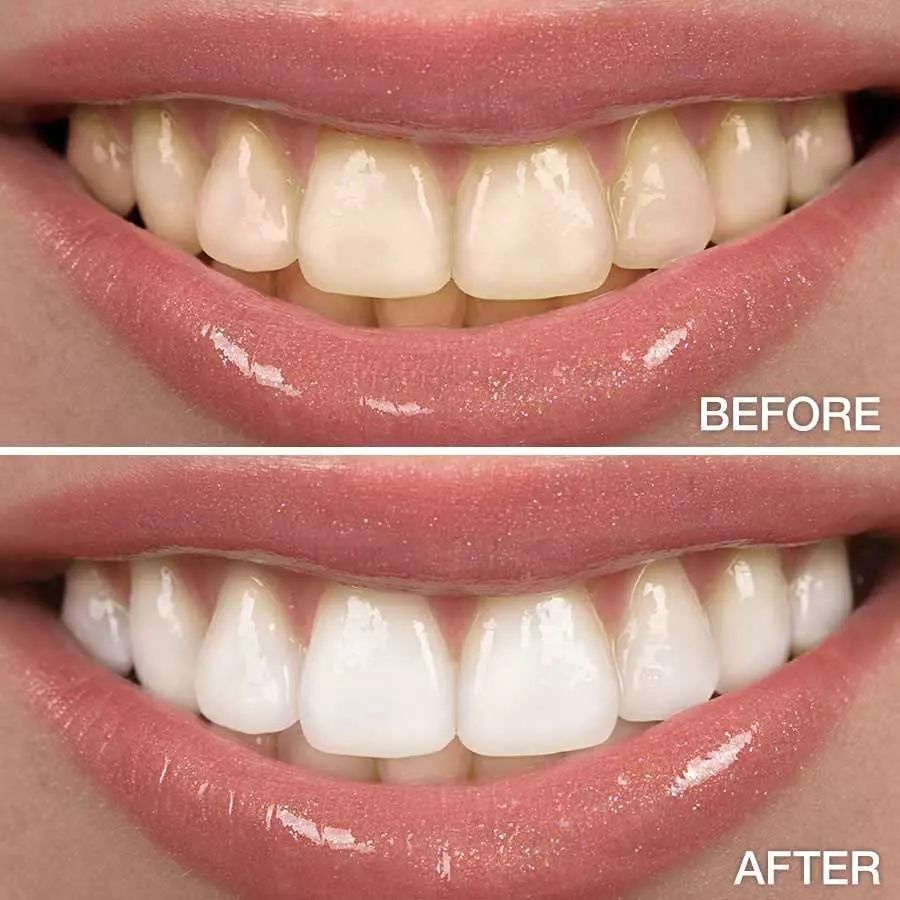 روش های بلیچینگ دندان - زیبایی دندان با بلیچینگ | فیروز دنتال
