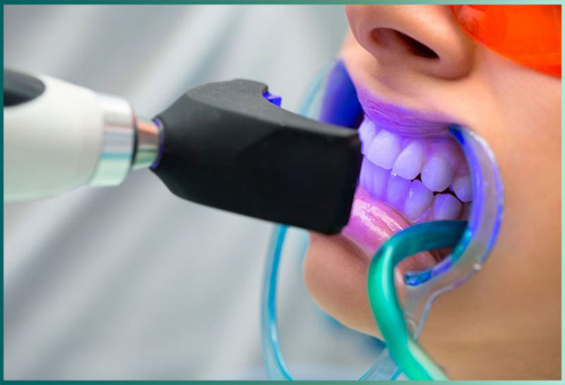 مزایای بلیچینگ دندان | فیروز دنتال