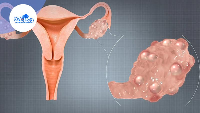 برش مقطعی گرافیکی از رحم که یک تخمدان پر از کیست از آن جدا و بزرگنمایی شده است، و از نزدیک قابل مشاهده است.