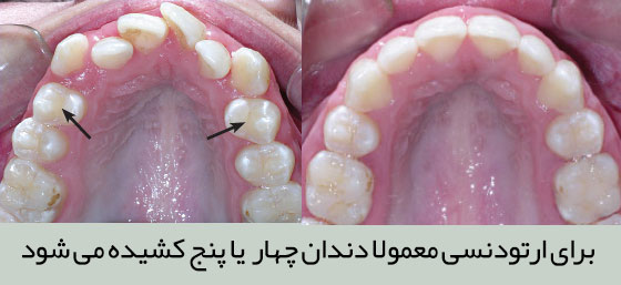 در ارتودنسی معمولا دندان های 4 و 5 کشیده می شود