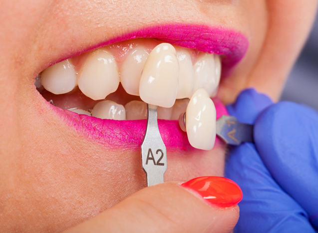 ماندگاری لمینت دندان بیشتر است یا کامپوزیت؟