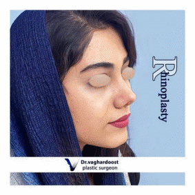 جراحی بینی و بهترین جراح بینی در تهران