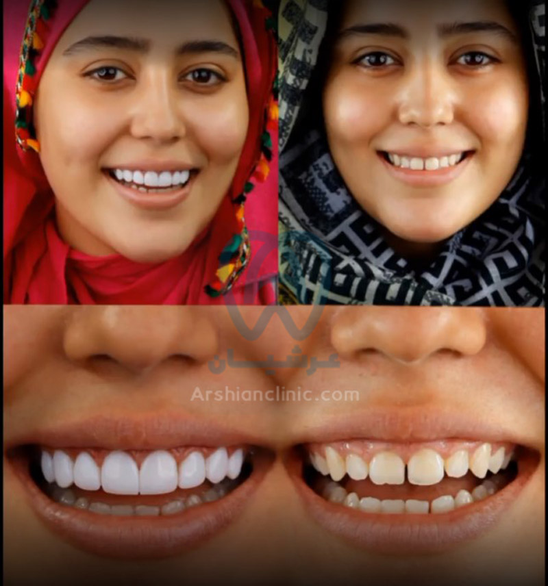 عکس کامپوزیت دندان قبل و بعد
