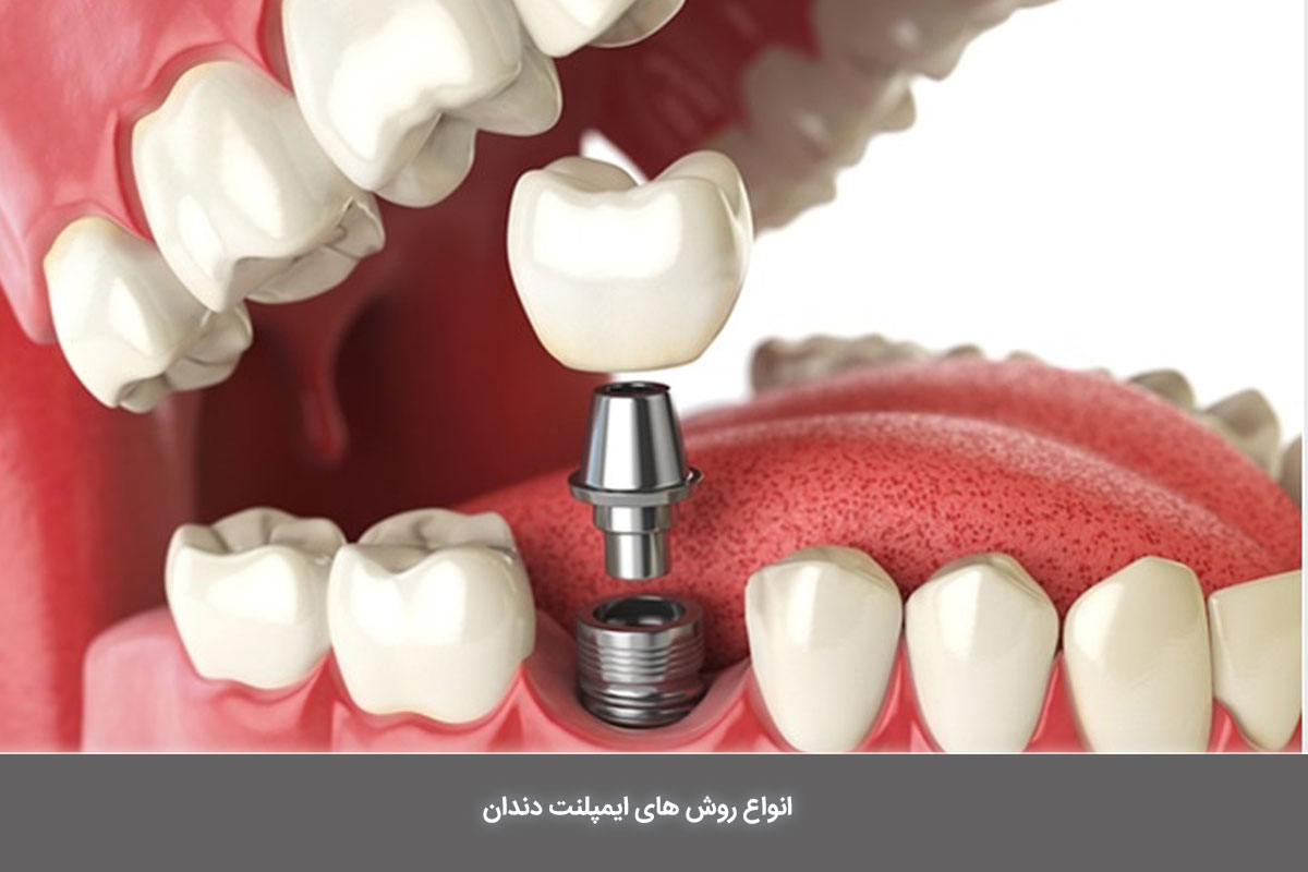 روش های کاشت ایمپلنت دندان