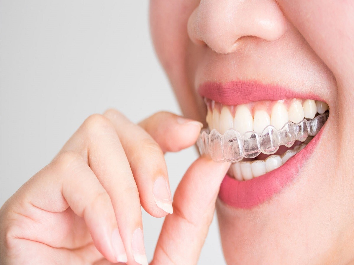 بهترین روش ارتودنسی دندان