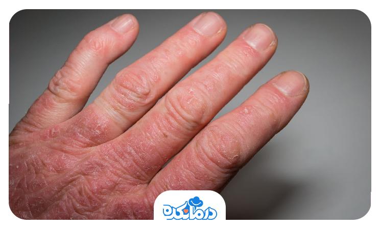 تصویر دست مردی که اختلال پوستی پسوریازیس دارد