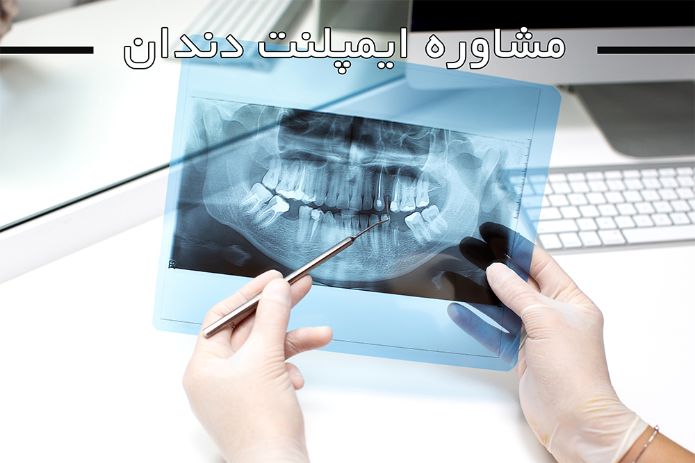 مشاوره ایمپلنت دندان