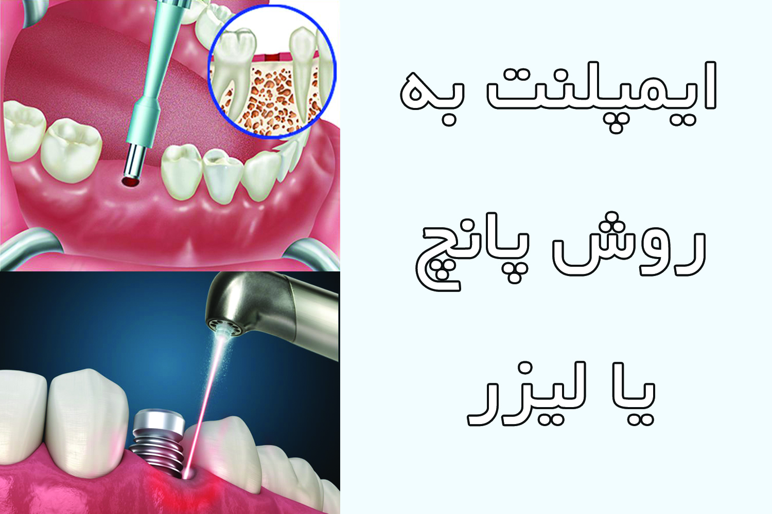 ایمپلنت به روش پانچ یا لیزر