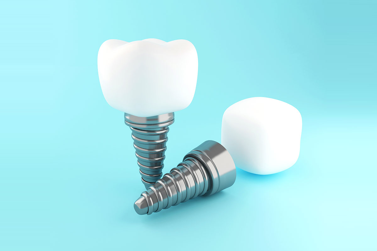 هزینه ایمپلنت دندان در آلمان به چه مواردی وابسته است؟