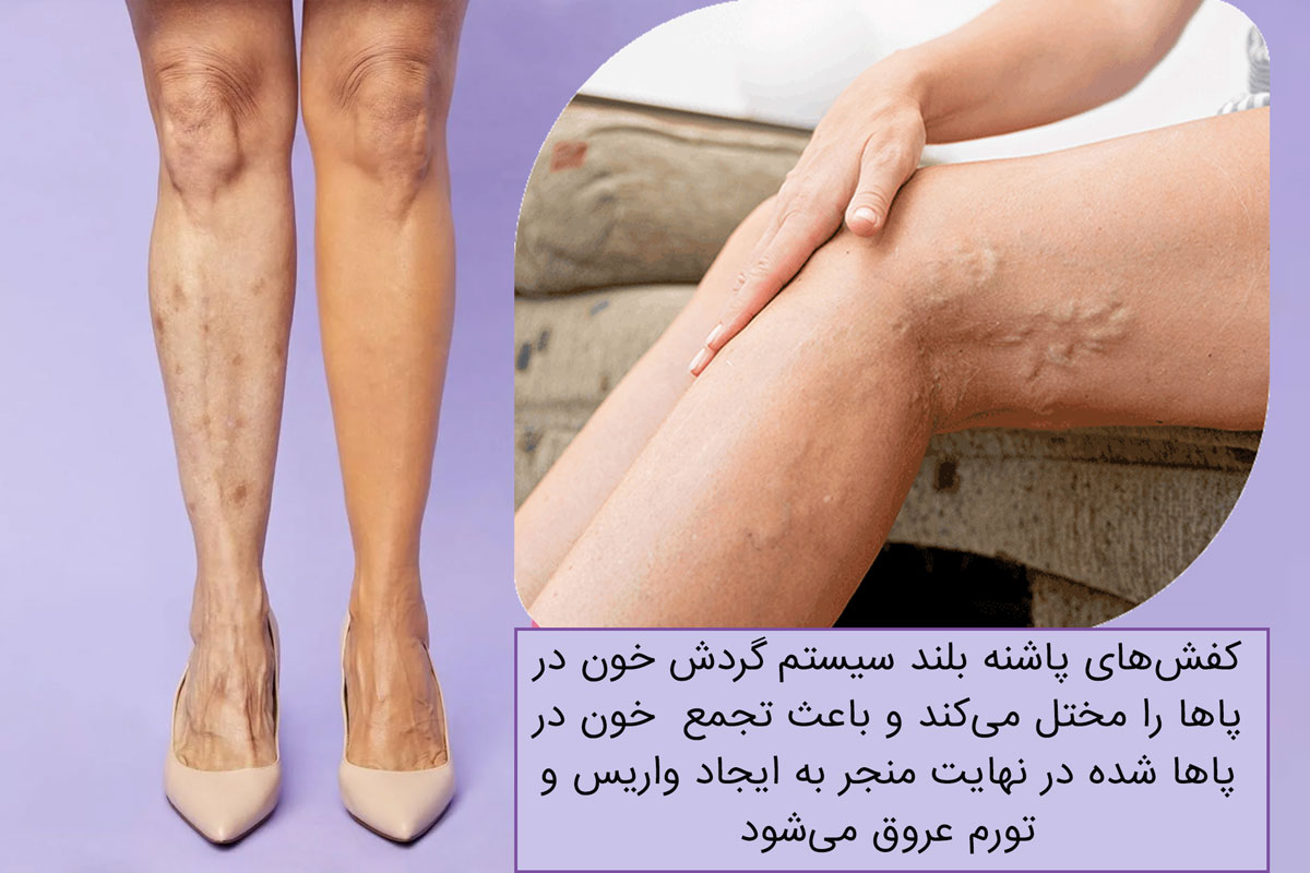 عوارض کفش پاشنه بلند بر پاها و رگهای واریسی
