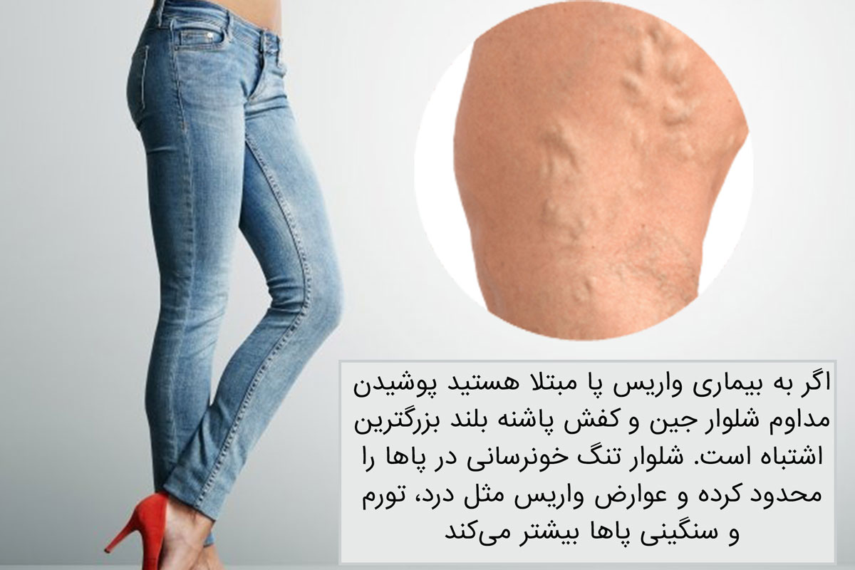 عوارض شلوار تنگ بر سلامت پاها و رگ های واریسی