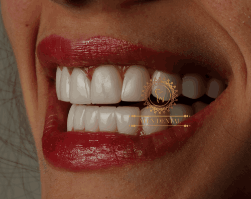 فواید ونیر کامپوزیت دندان