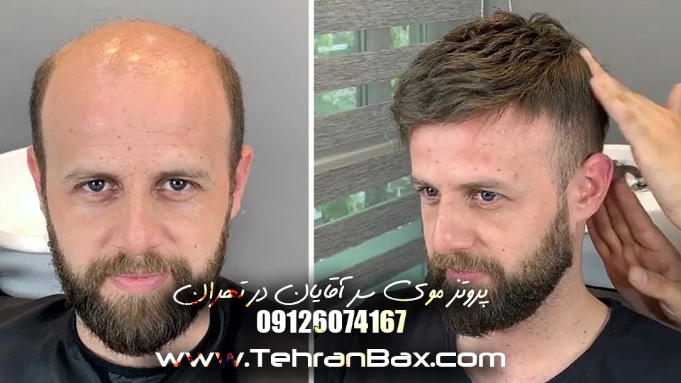پروتز موی آقایان در سالن داماد حمید بخشی | تهران بکس