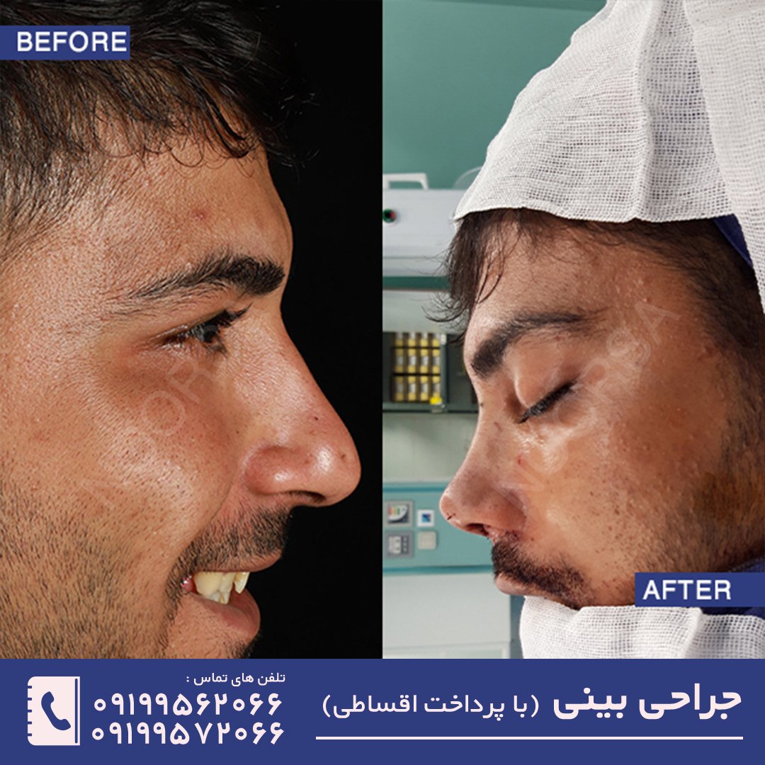 قبل و بعد از عمل بینی