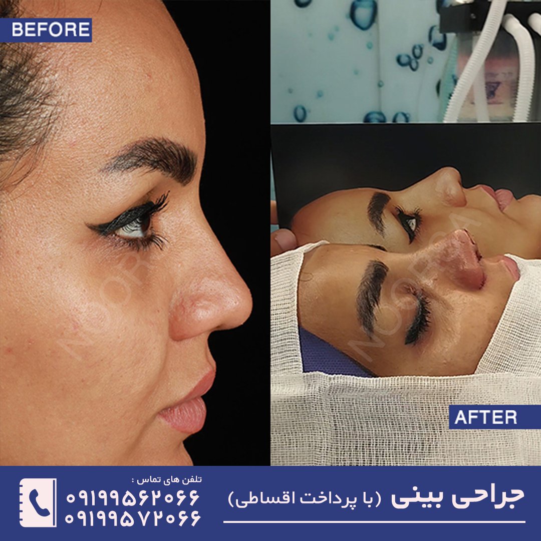 عمل بینی طبیعی
