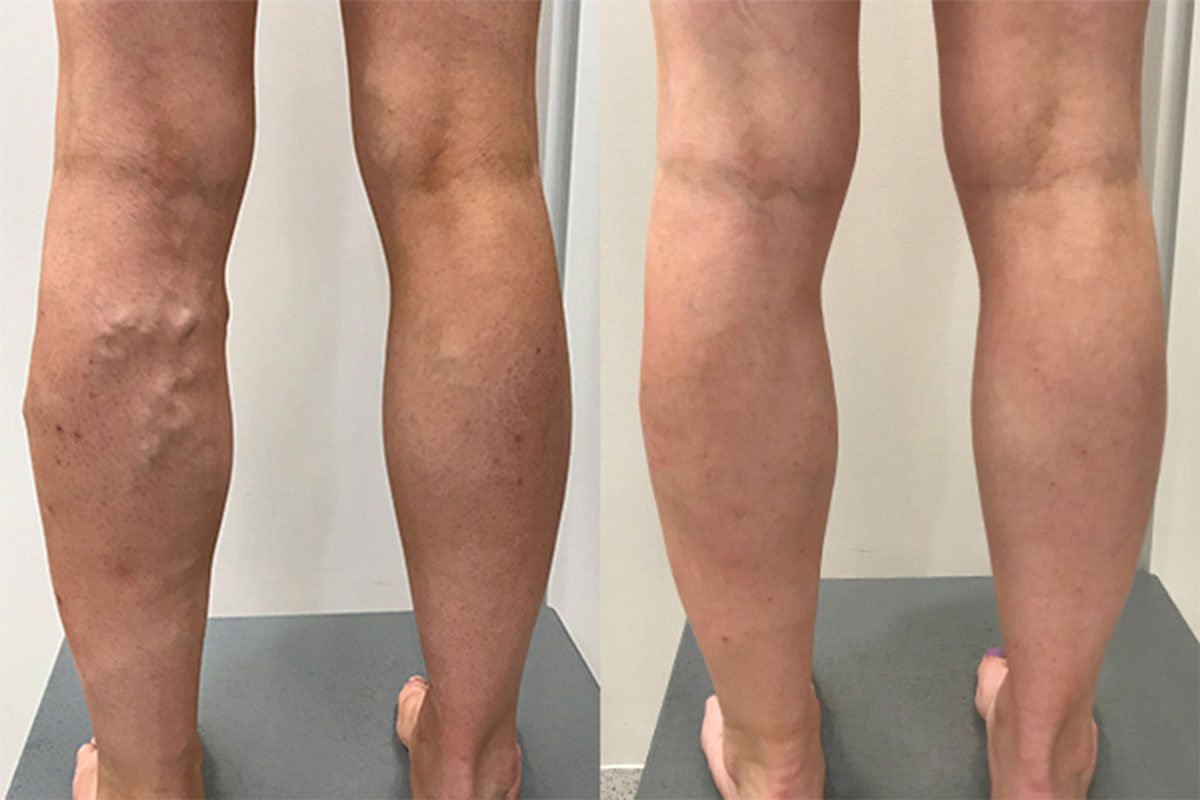 عکس قبل و بعد از درمان واریس