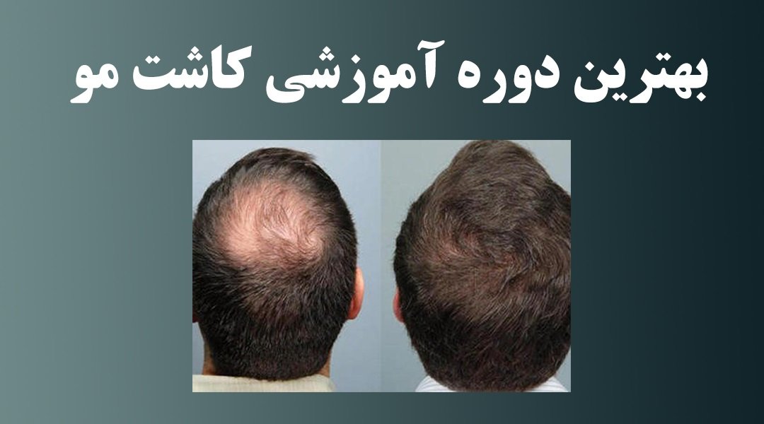 بهترین دوره آموزش کاشت مو در ایران