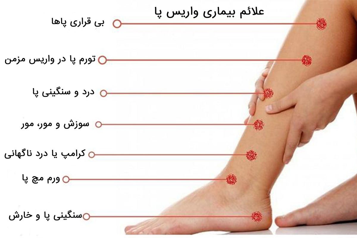 علائم واریس پا