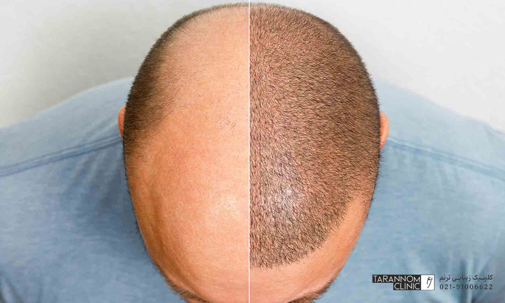 تصویر قبل و بعد متقاضی آقا در عمل کاشت مو