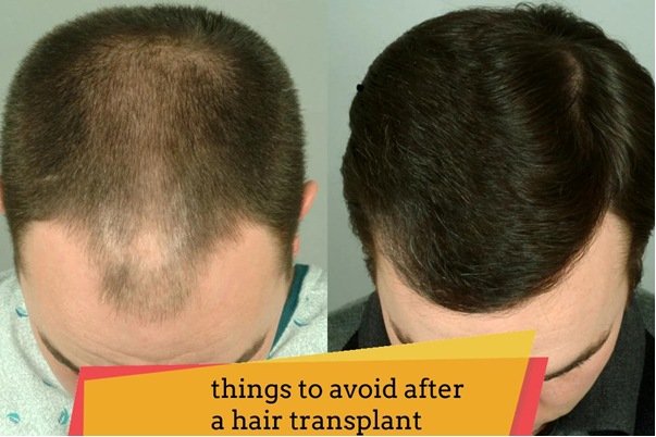 things to avoid after a hair transplant